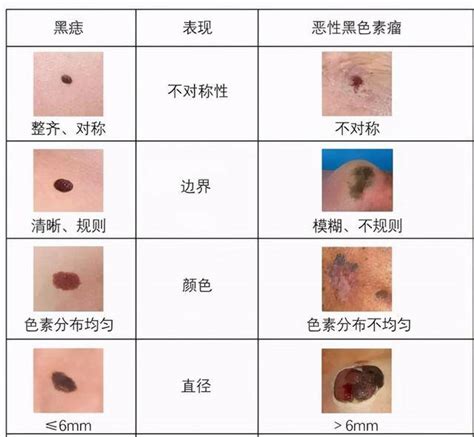 龟头痣|龟头上长黑痣是怎么回事（男，28岁）